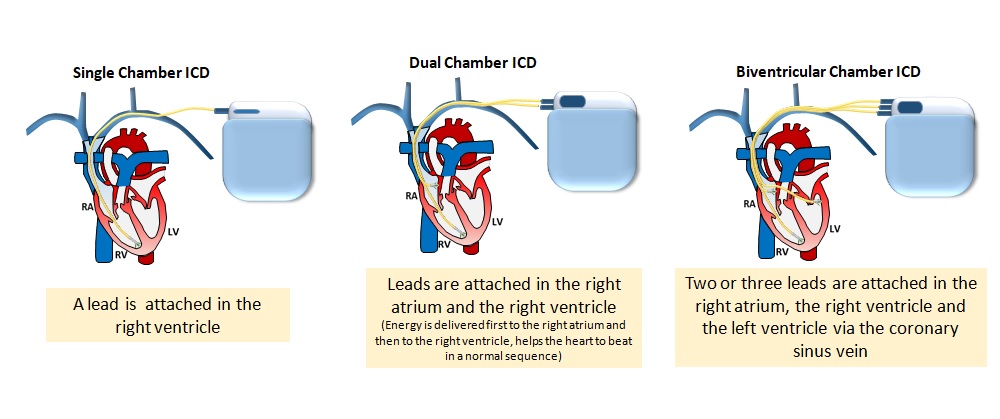 Types of ICDs